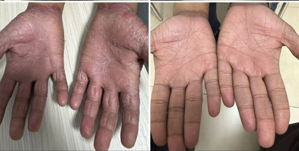 Psoriasis