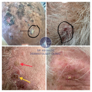Actinic Keratosis