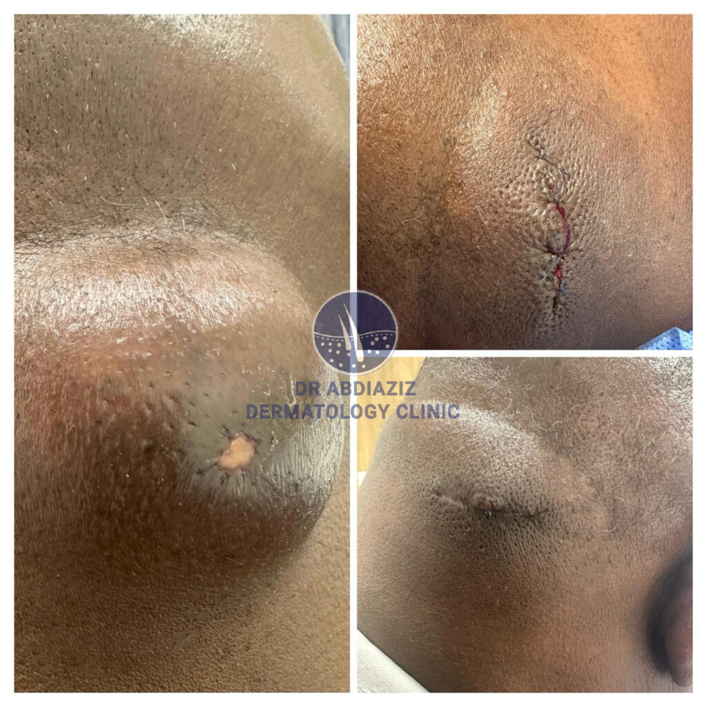 Epidermoid Cyst