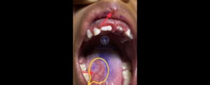 Aphthous ulcer