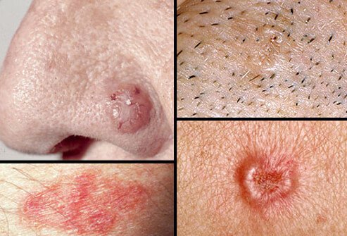 Basal Cell Carcinoma (BCC)